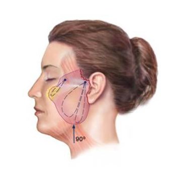 Mi Proceso de Lifting Facial - MACOM